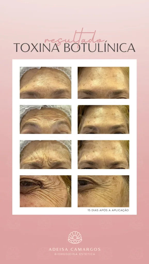 Resultado Antes e Depois botox toxina botulínica para rugas em pele madura