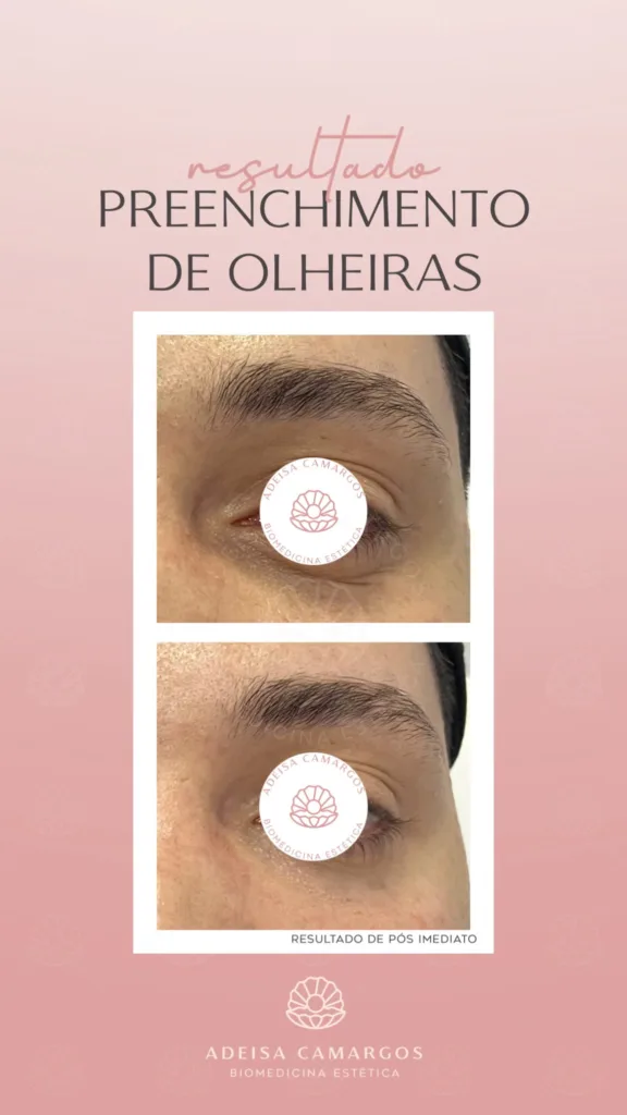 Resultado Antes e Depois preenchimento de olheiras com ácido hialurônico