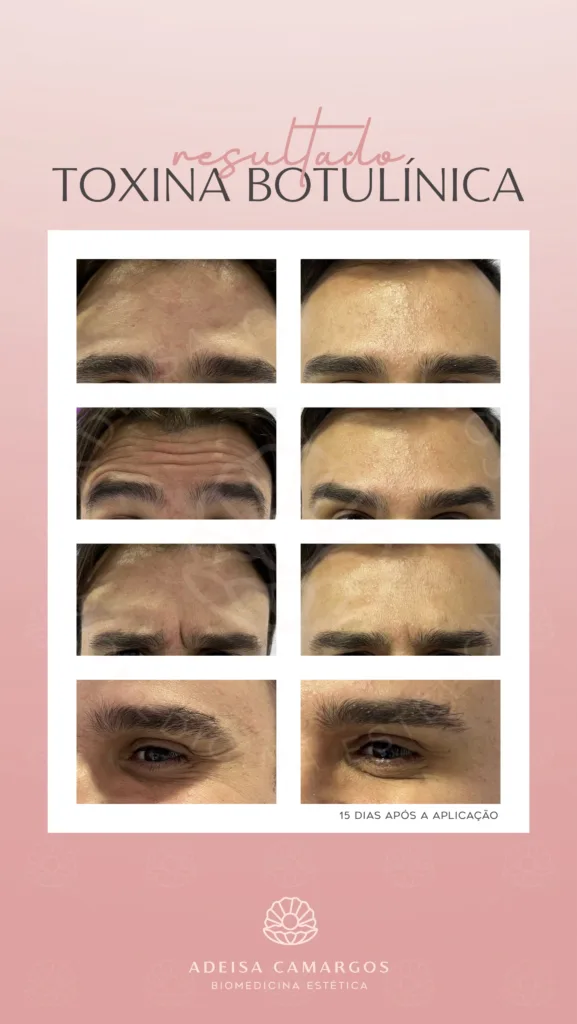 Resultado Antes e Depois botox toxina botulínica para rugas de homens - Adeisa Camargos - Botox para homens - Betim-MG