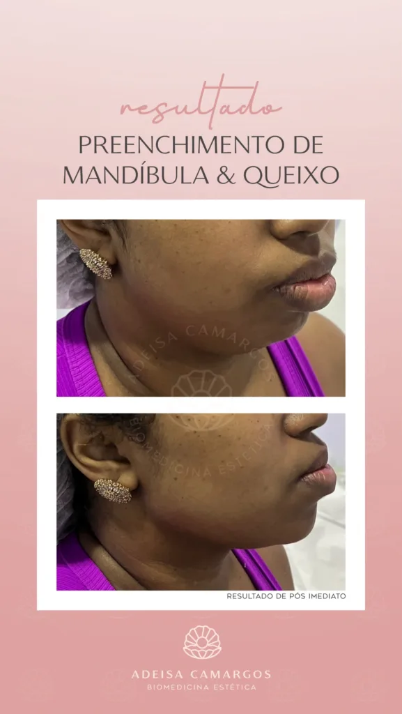 Resultados Antes e Depois da Dra. Adeisa Camargos 51 Adeisa Camargos Resultado Antes e Depois preenchimento de mandíbula