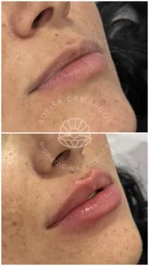 Adeisa Camargos - preenchimento labial resultado antes e depois
