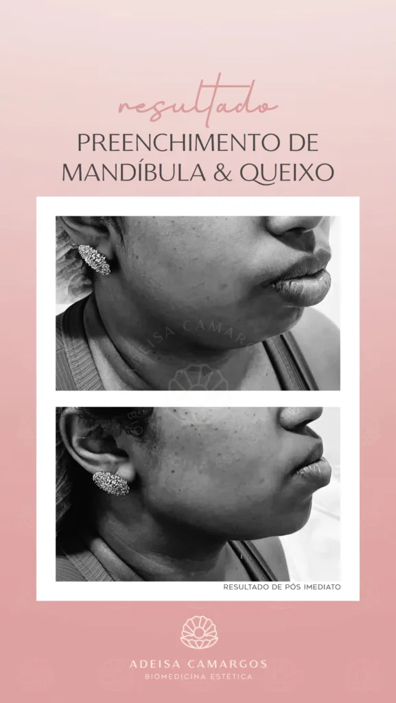 Resultado Antes e Depois preenchimento de mandíbula