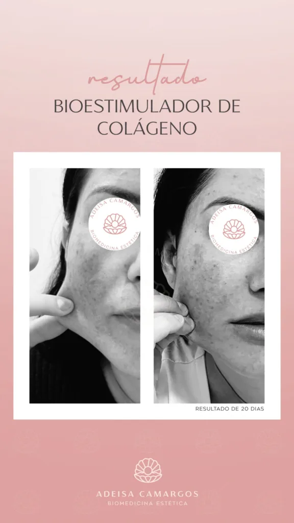 Resultado Antes e Depois bioestimulador de colágeno