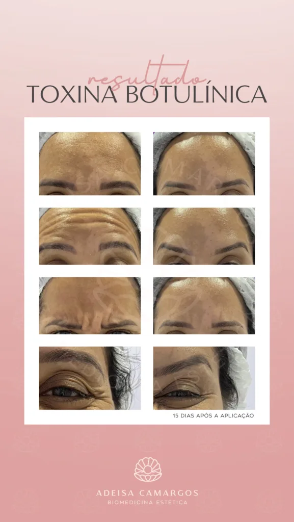 Resultado Antes e Depois toxina botulínica para rugas em mulher