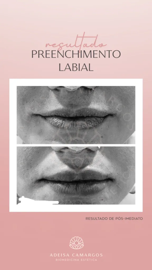 Resultados Antes e Depois da Dra. Adeisa Camargos 33 Adeisa Camargos Resultado Antes e Depois Preenchimento Labial Leve volume