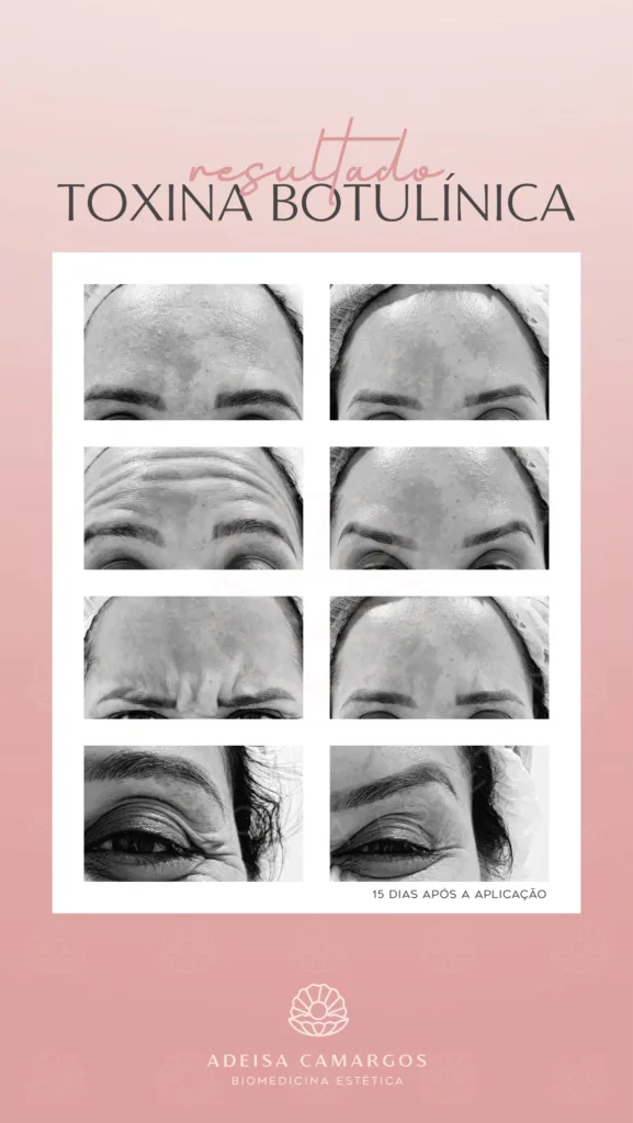 Resultado Antes e Depois botox toxina botulínica para rugas em mulher