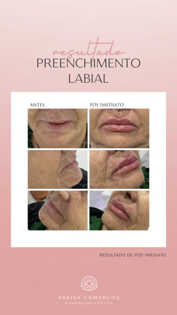 Resultado Antes e Depois Preenchimento Labial para rejuvenescimento e melhora dos cóigos de barra