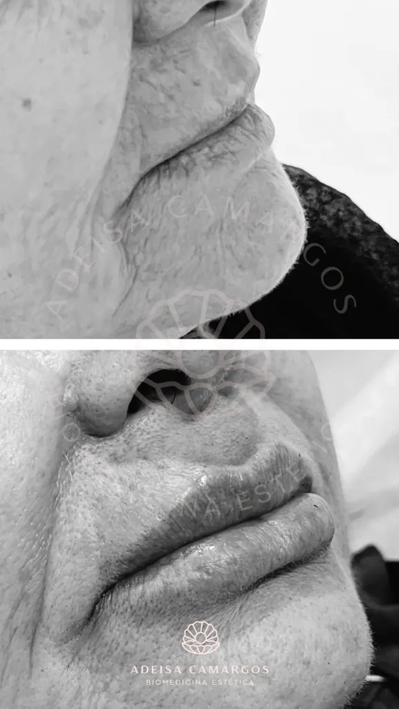 Resultados Antes e Depois da Dra. Adeisa Camargos 34 Adeisa Camargos Resultado Antes e Depois Preenchimento Labial para rejuvenescimento e melhora dos cóigos de barra