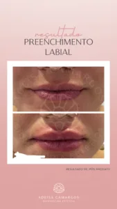 Resultados Reais de Preenchimento Labial Natural Preenchimento Labial Natural