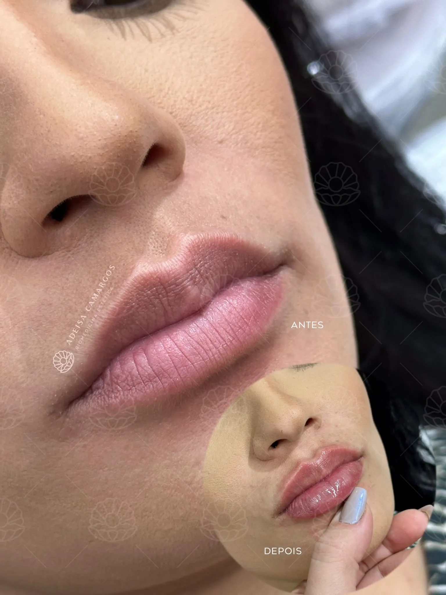 Preenchimento Labial 29 Adeisa Camargos Preenchimento Labial preenchimento labial