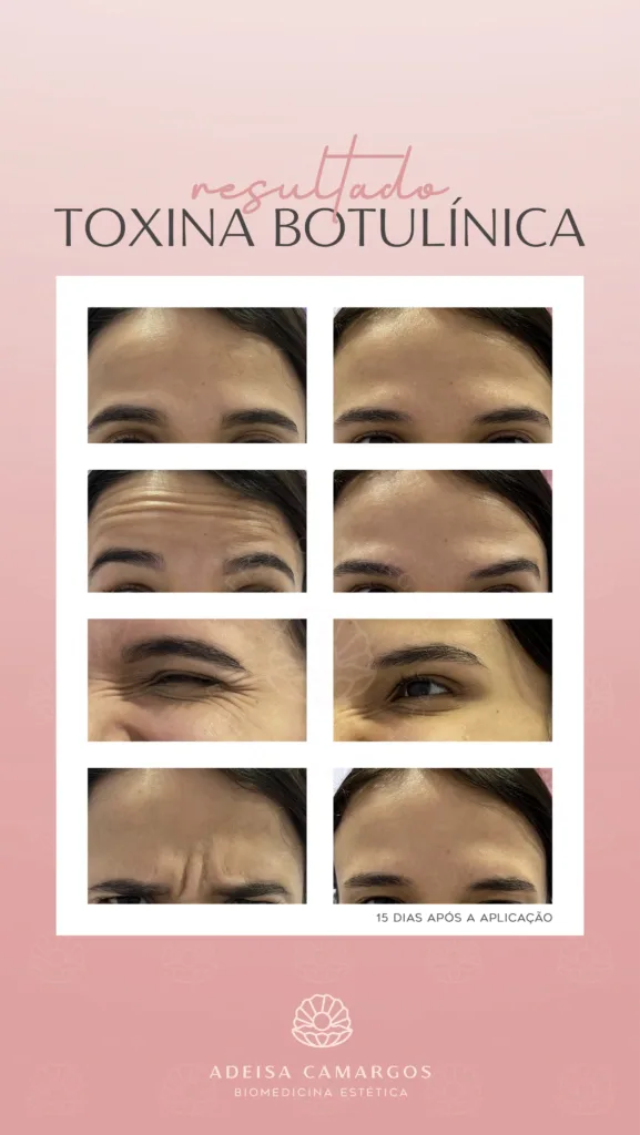 Resultado Antes e Depois botox toxina botulínica preventivo - Adeisa Camargos - Botox para homens - Betim-MG