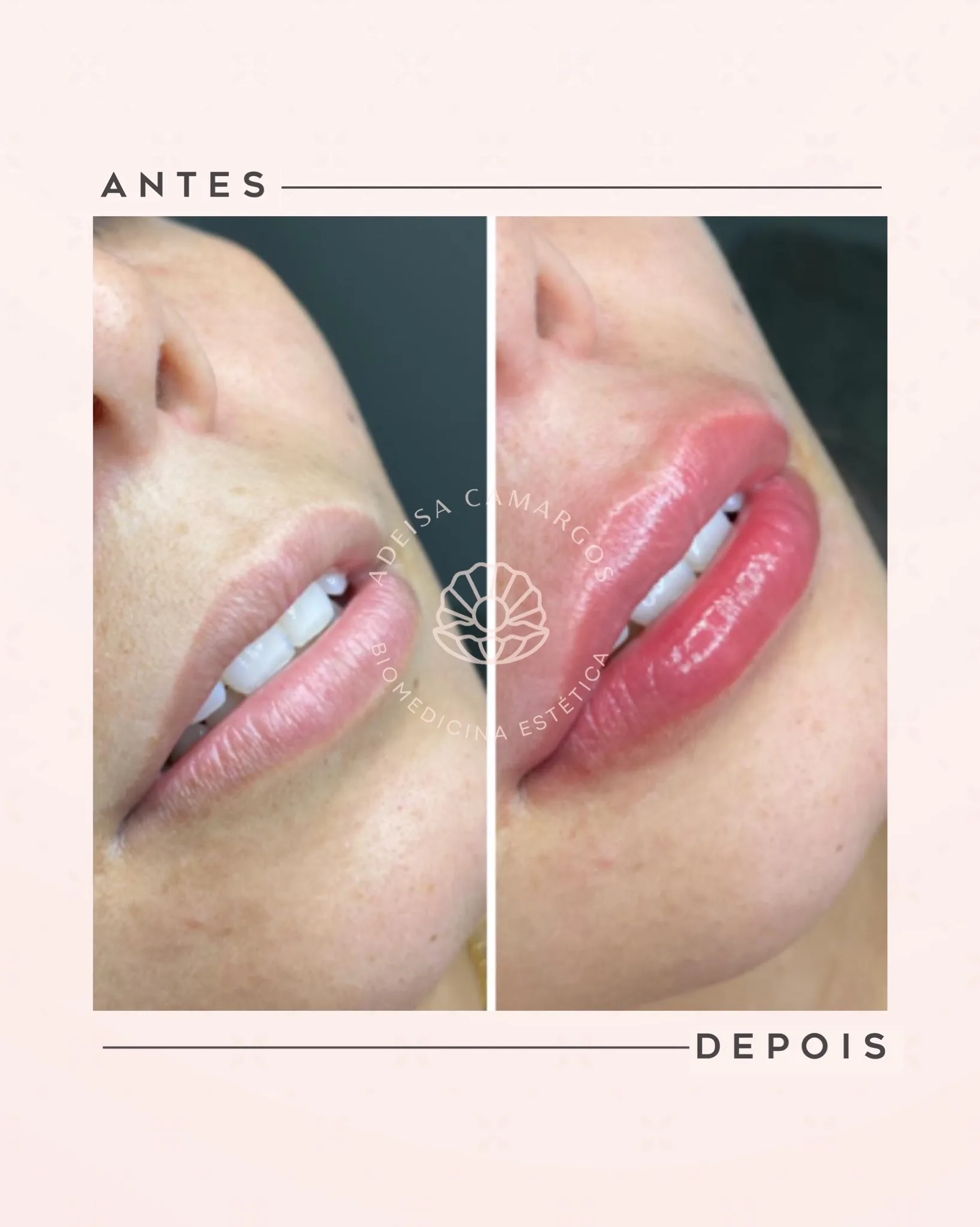 Resultado Antes e Depois Preenchimento Labial. Esta imagem não representa, em hipótese alguma, garantia de resultado. Cada ser humano tem características anatômicas e fisiológicas únicas. Divulgação autorizada em TCLE e autorizada pelo usuário.