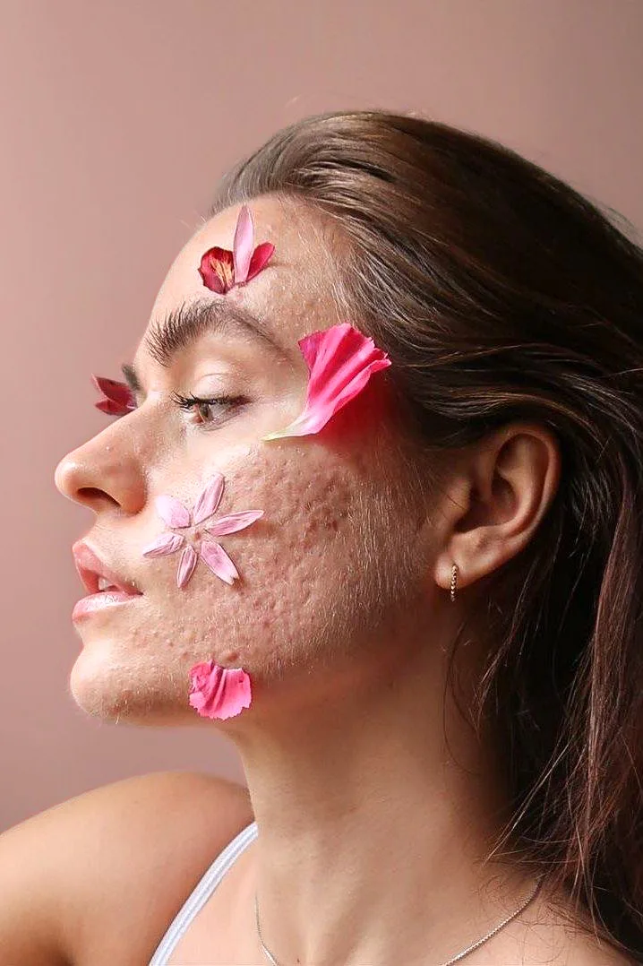Adeisa Camargos - Tratamentos estéticos para cicatriz de acne e espinhas