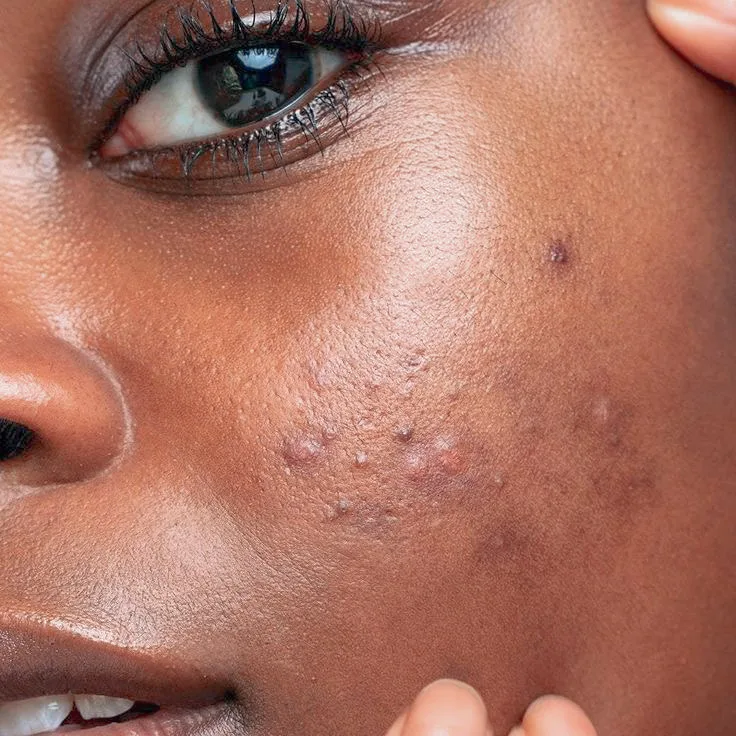 Dra. Adeisa Camargos, biomédica especialista em Estética Avançada e Tratamentos para acne