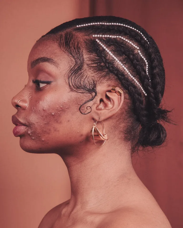 Adeisa Camargos - Tratamentos estéticos para acne