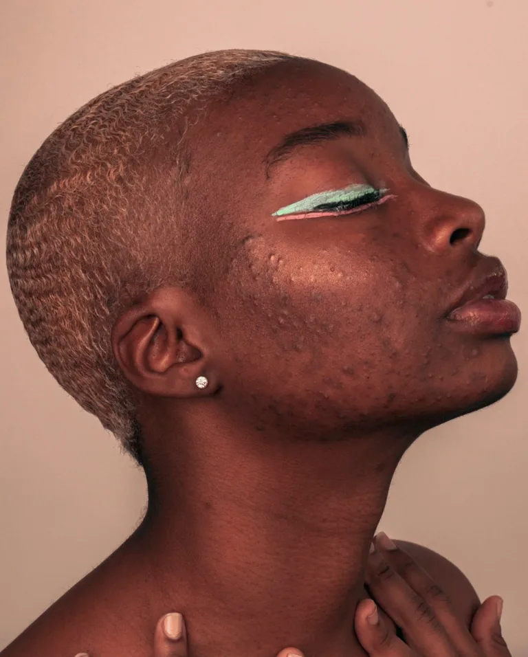 Adeisa Camargos - Tratamentos estéticos para acne