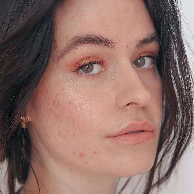 Adeisa Camargos - Tratamentos estéticos para acne e espinhas