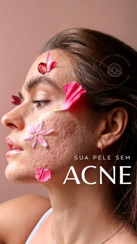 Adeisa Camargos - Tratamentos estéticos para acne e espinhas