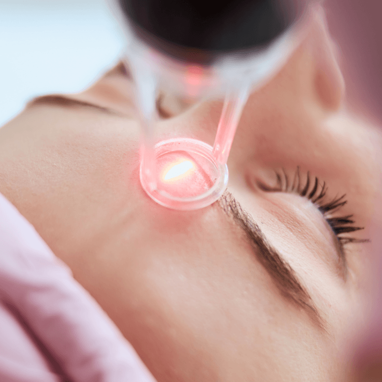Adeisa Camargos - biomedicina estética - aplicação laser de pele - laser lavieen