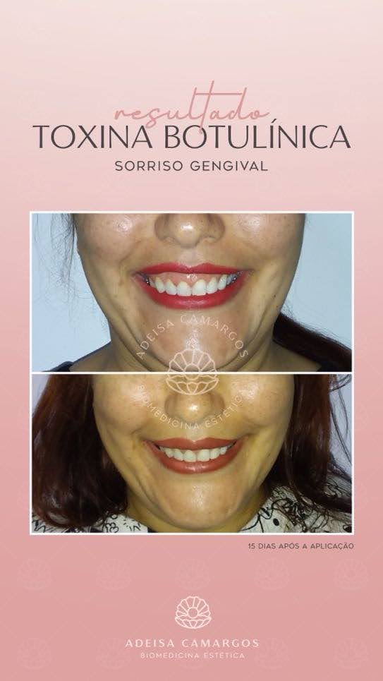Resultado Antes e Depois botox Sorriso Gengival.