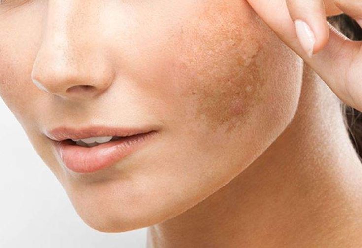 Tratamento para Melasma