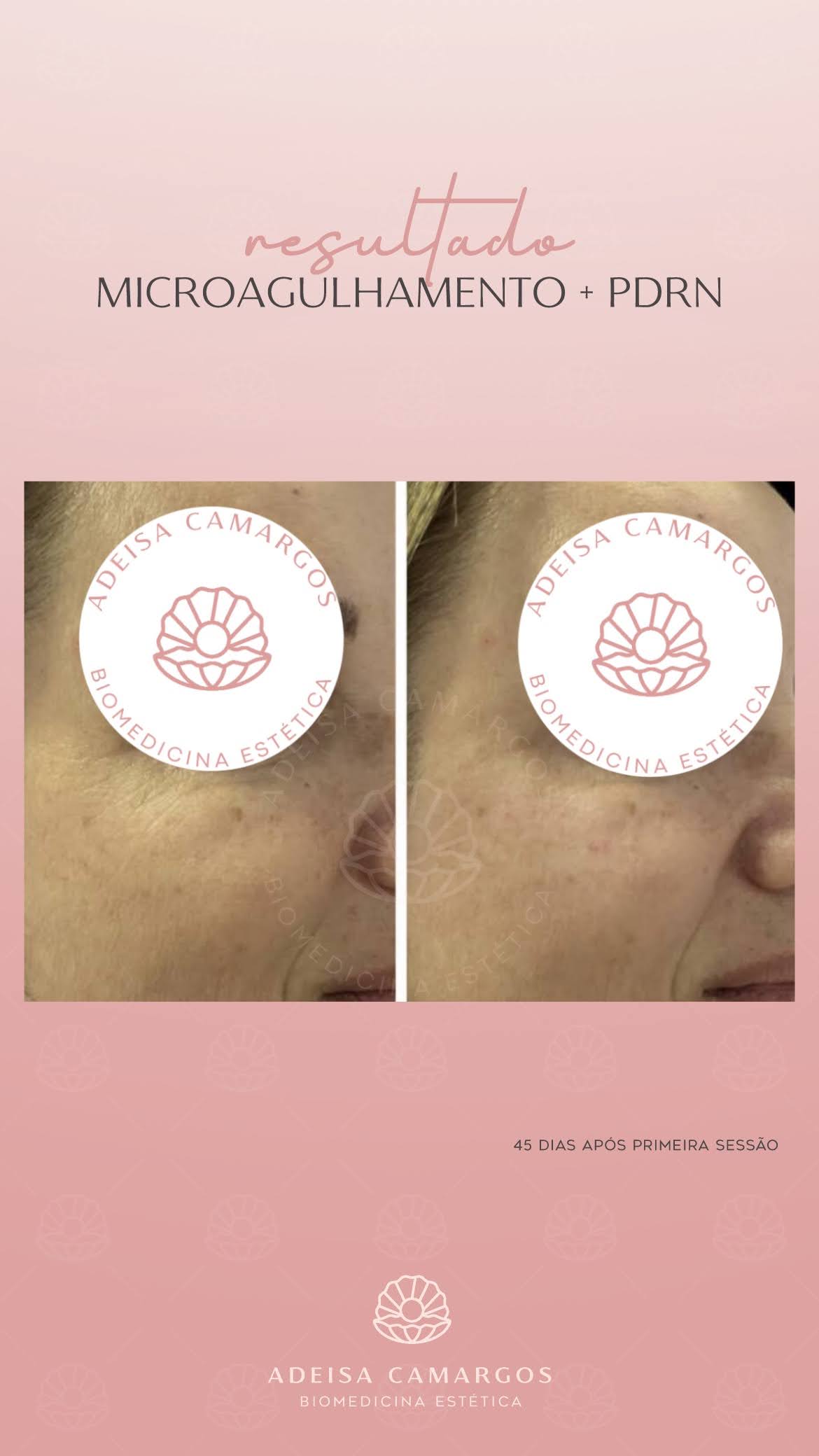 Resultado PDRN rugas linhas finas dos olhos. Esta imagem não representa, em hipótese alguma, garantia de resultado. Cada ser humano tem características anatômicas e fisiológicas únicas. Divulgação autorizada em TCLE e autorizada pelo usuário.