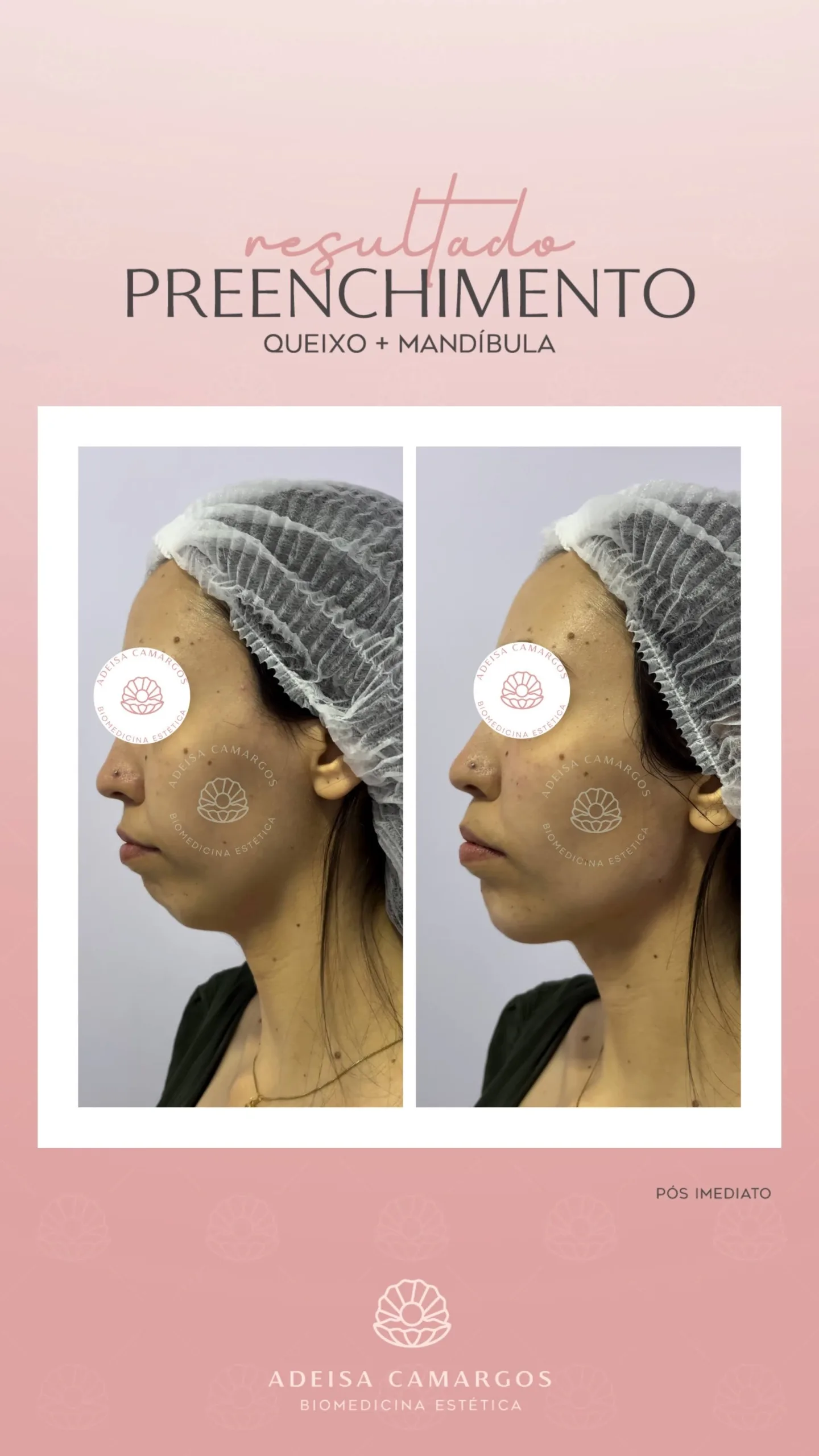 Resultado Antes e Depois Preenchimento Quiexo e Mandíbula. Esta imagem não representa, em hipótese alguma, garantia de resultado. Cada ser humano tem características anatômicas e fisiológicas únicas. Divulgação autorizada em TCLE e autorizada pelo usuário.