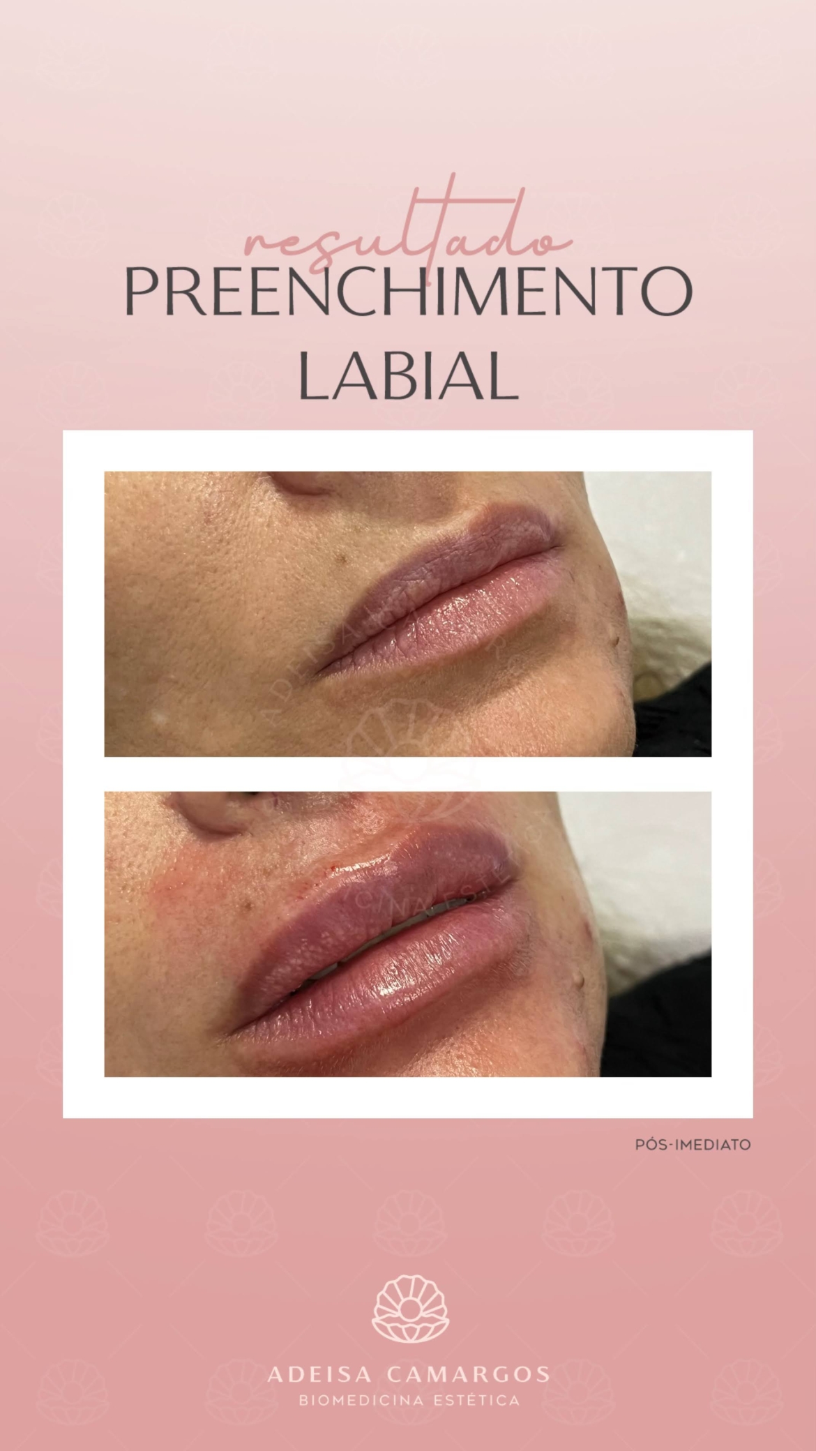 Resultado Antes e Depois Preenchimento Labial. Esta imagem não representa, em hipótese alguma, garantia de resultado. Cada ser humano tem características anatômicas e fisiológicas únicas. Divulgação autorizada em TCLE e autorizada pelo usuário.