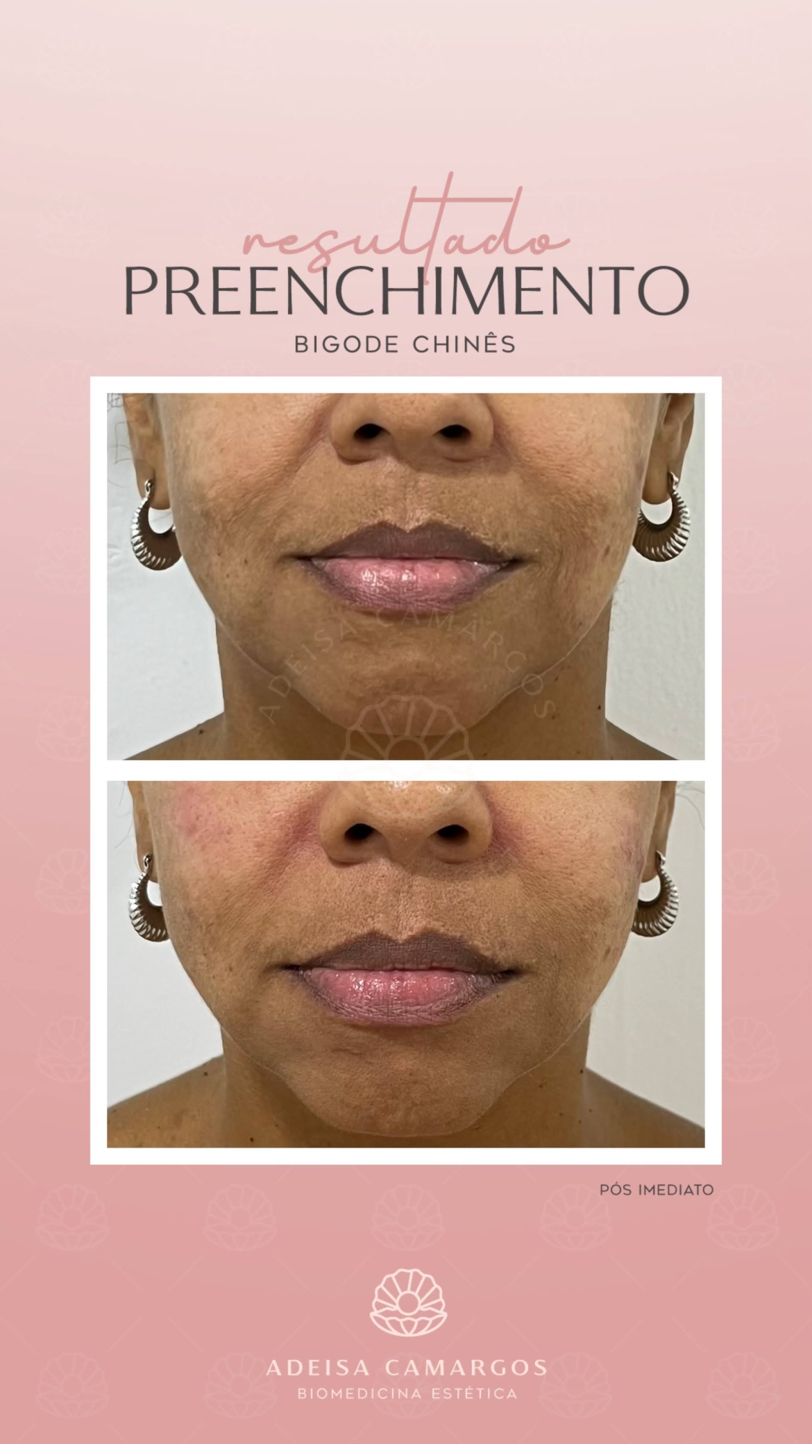 Resultado Antes e Depois Preenchimento Sulconasogeniano. Esta imagem não representa, em hipótese alguma, garantia de resultado. Cada ser humano tem características anatômicas e fisiológicas únicas. Divulgação autorizada em TCLE e autorizada pelo usuário.