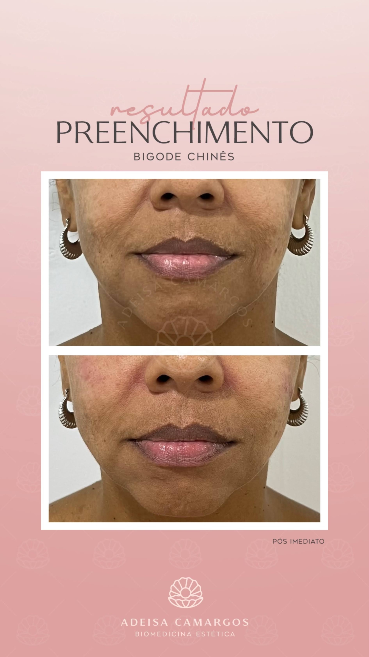 Harmonização Facial em Betim 33 Adeisa Camargos Resultado Antes e Depois Preenchimento Sulconasogeniano. Esta imagem não representa, em hipótese alguma, garantia de resultado. Cada ser humano tem características anatômicas e fisiológicas únicas. Divulgação autorizada em TCLE e autorizada pelo usuário.