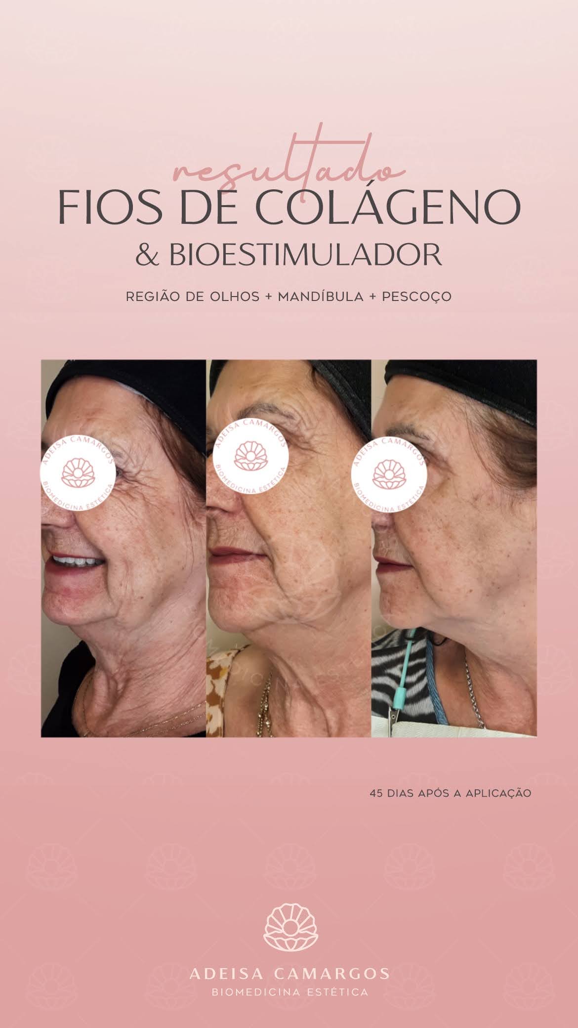 Resultado Antes e Depois Fios e Bioestimulador. Esta imagem não representa, em hipótese alguma, garantia de resultado. Cada ser humano tem características anatômicas e fisiológicas únicas. Divulgação autorizada em TCLE e autorizada pelo usuário.