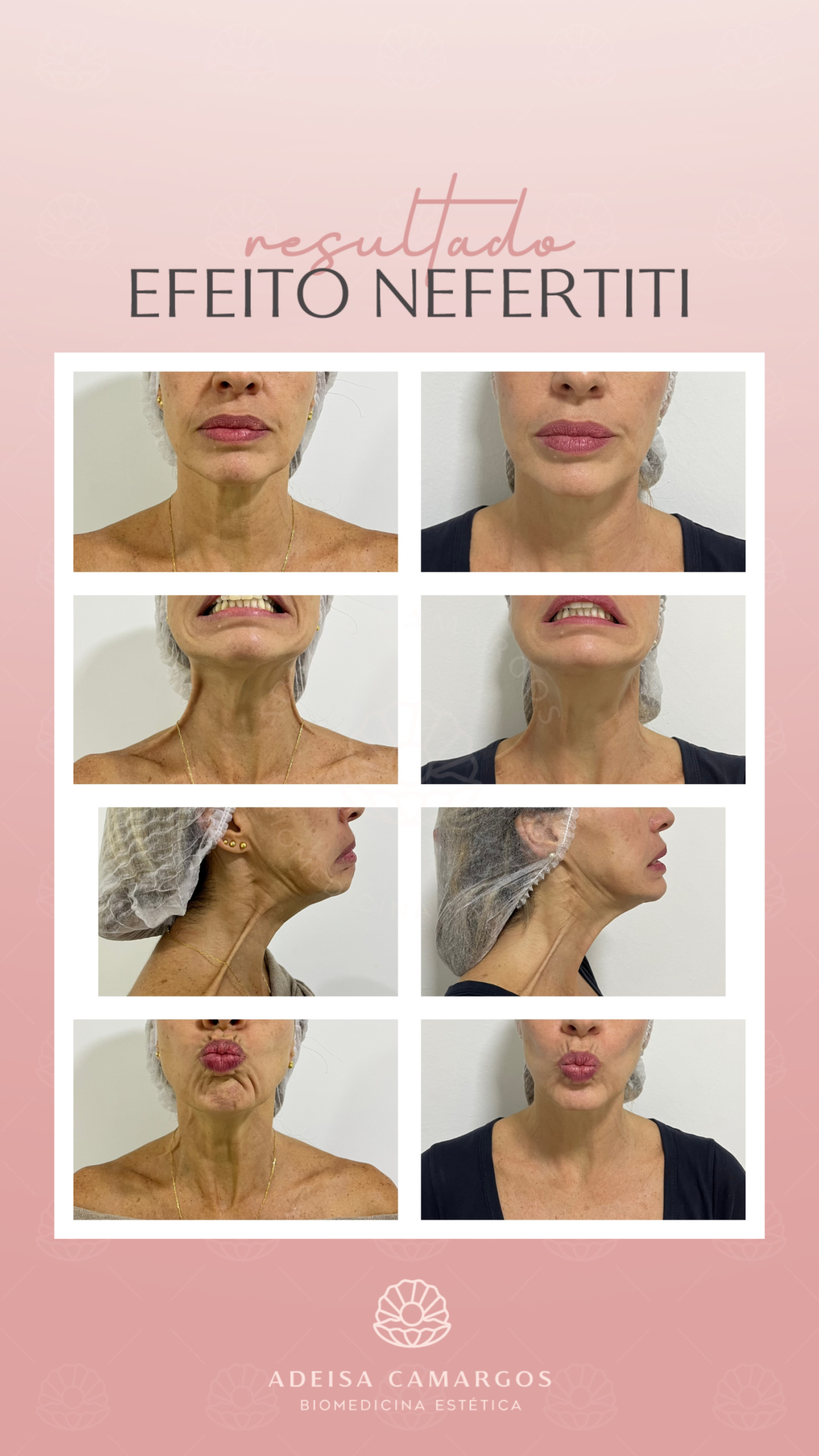 Resultados Antes e Depois da Dra. Adeisa Camargos Resultados Antes e Depois,Antes e depois