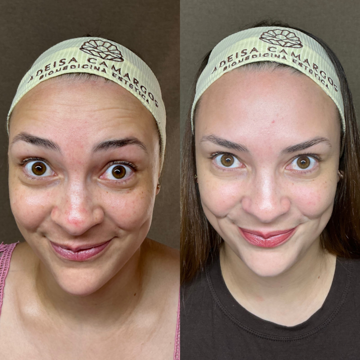 Resultados Reais de Preenchimento Labial Natural Preenchimento Labial Natural