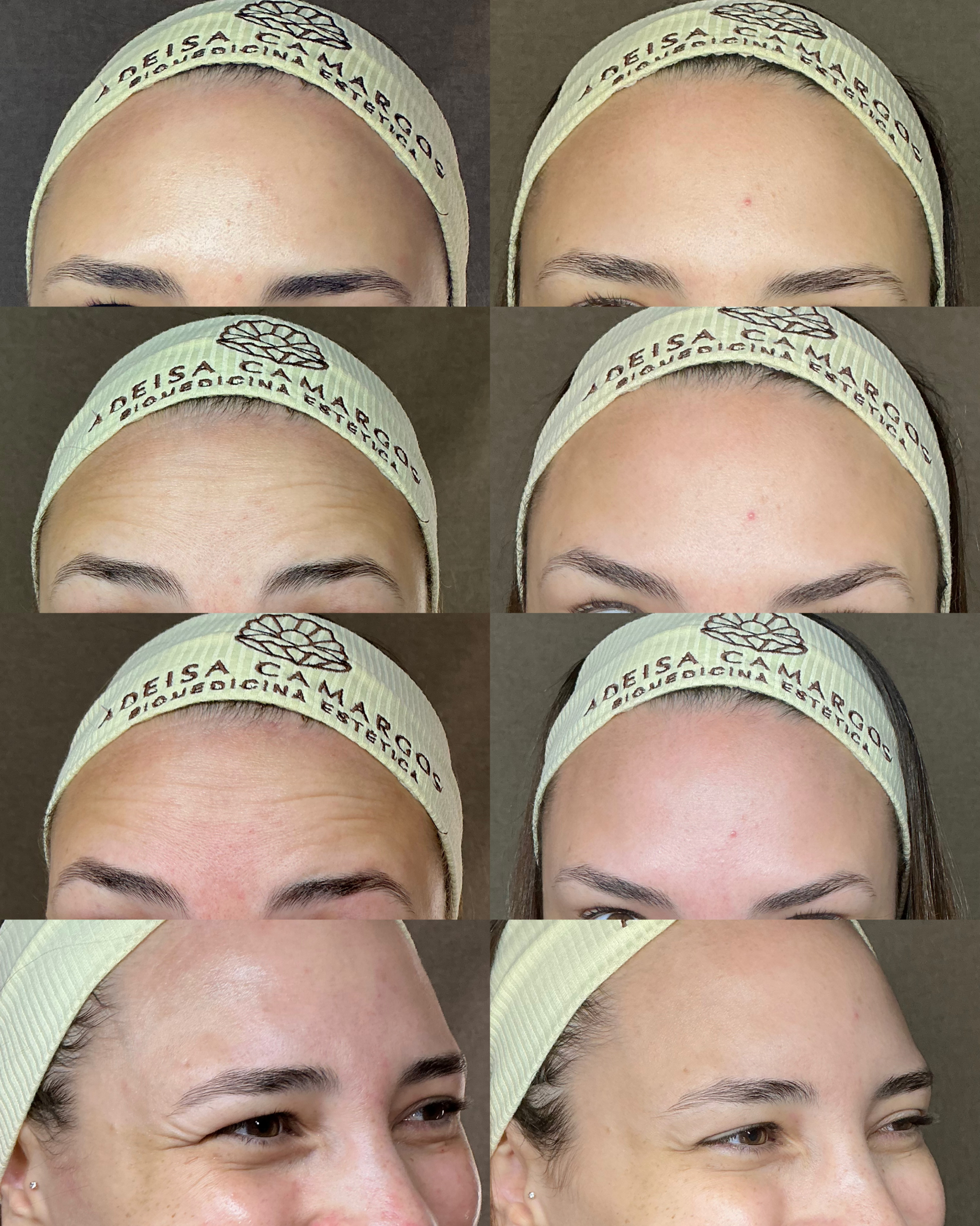 Adeísa Camargos - Clínica de Estética Avançada e Harmonização Facial em Betim e Região 26 Adeisa Camargos Adeísa Camargos - Clínica de Estética Avançada e Harmonização Facial em Betim e Região Adeisa Camargos,clínica de estética