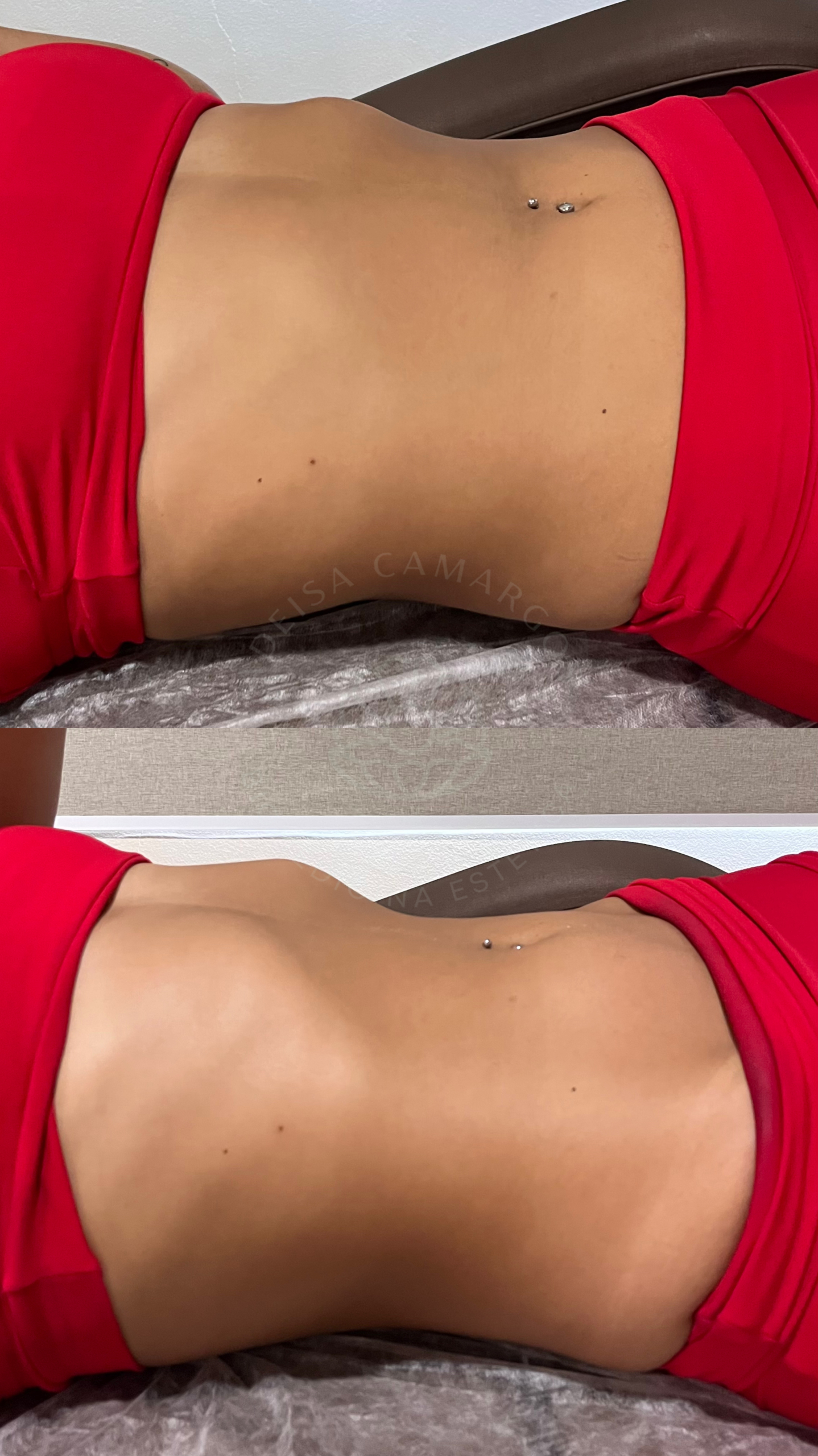 Resultado massagem modeladora - clínica de massagem em betim