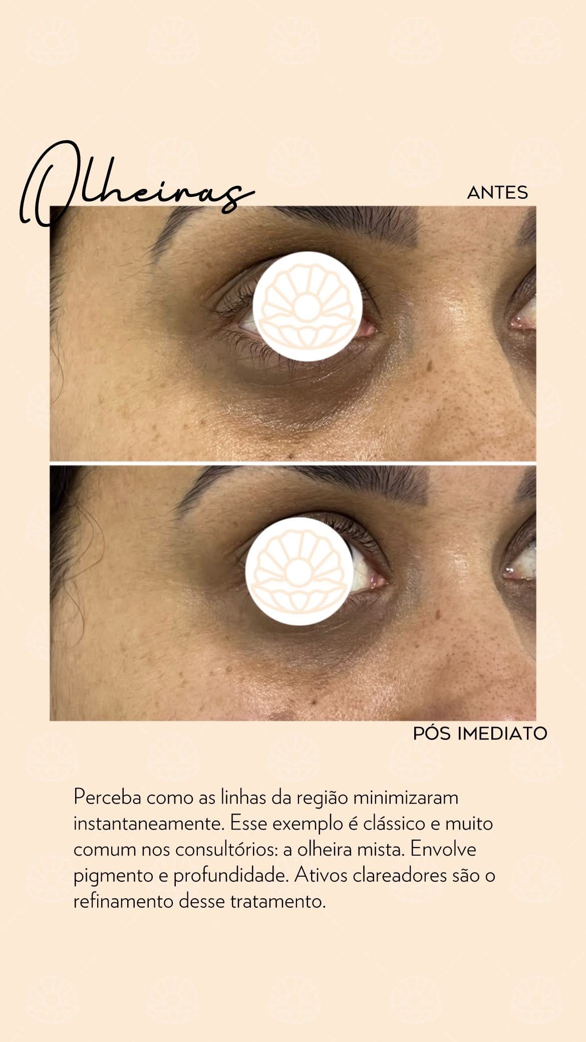 Tratamento Estético para Olheiras Profundas e Escurecidas olheiras,Olheiras Profundas,Tratamento Estético para Olheiras