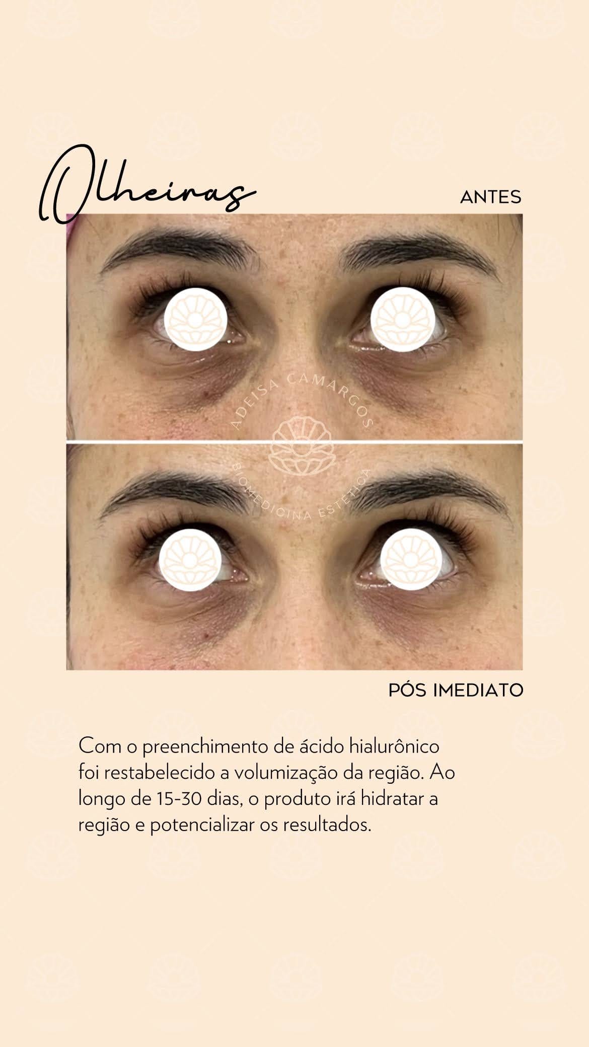 Tratamento Estético para Olheiras Profundas e Escurecidas olheiras,Olheiras Profundas,Tratamento Estético para Olheiras