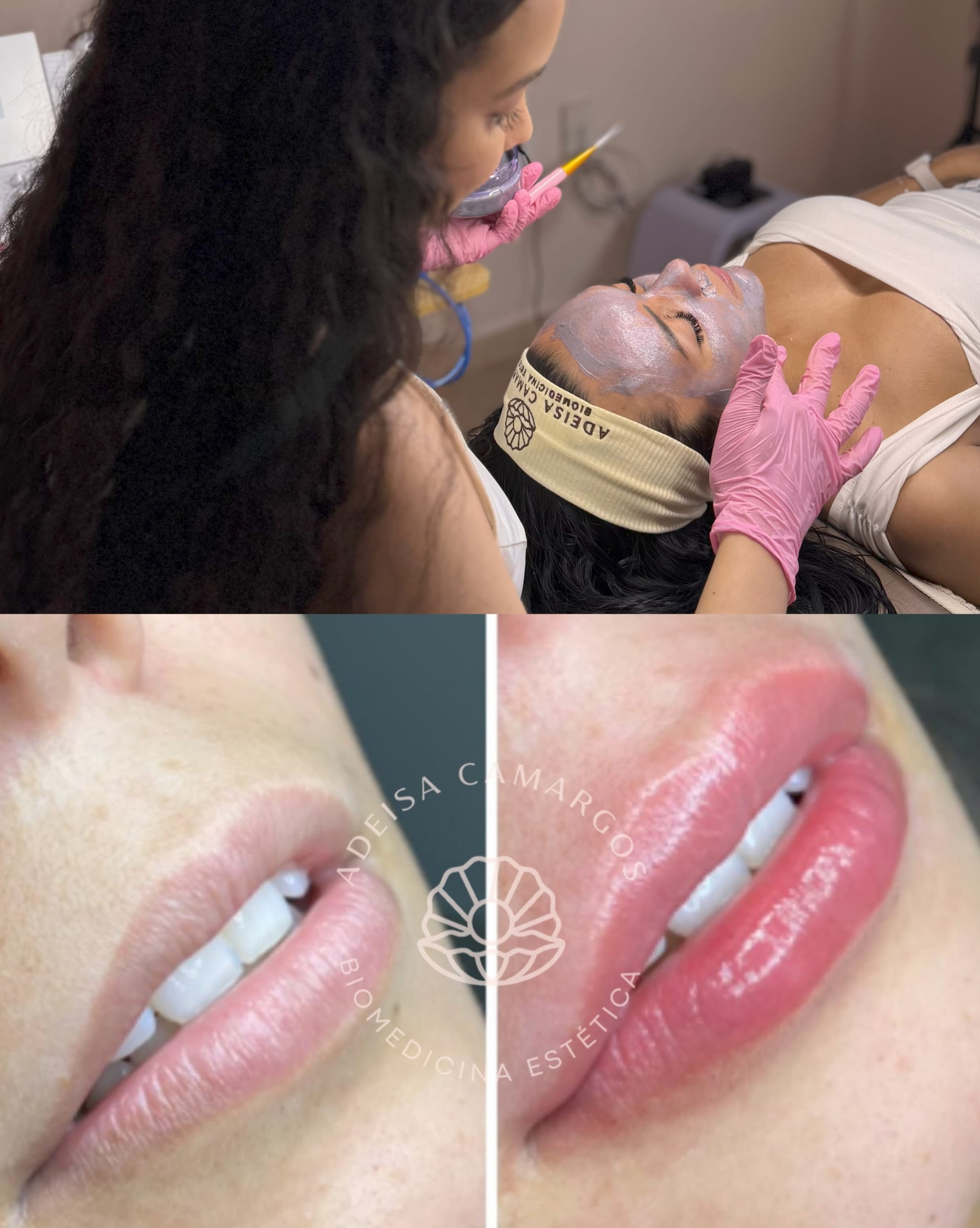 Dermofusion Régénérante: A Fusão do Microagulhamento e Peeling 12 Adeisa Camargos Dermofusion Régénérante: A Fusão do Microagulhamento e Peeling dermofusion